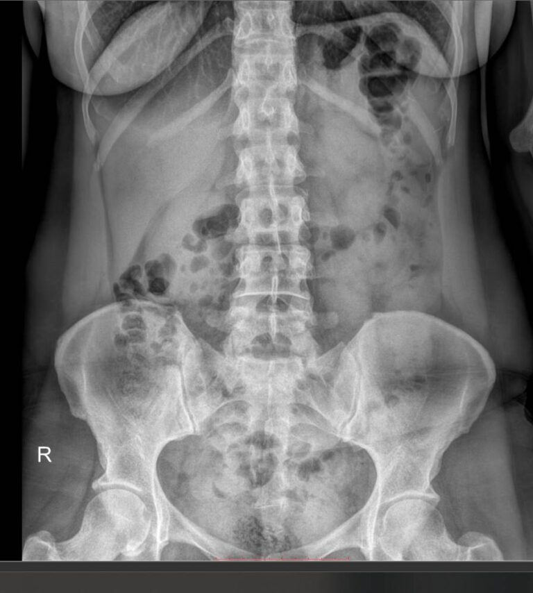 Рентген почек, мочеточников, мочевого пузыря