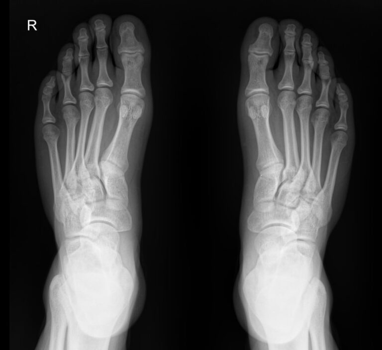 Рентген стоп в прямой проекции