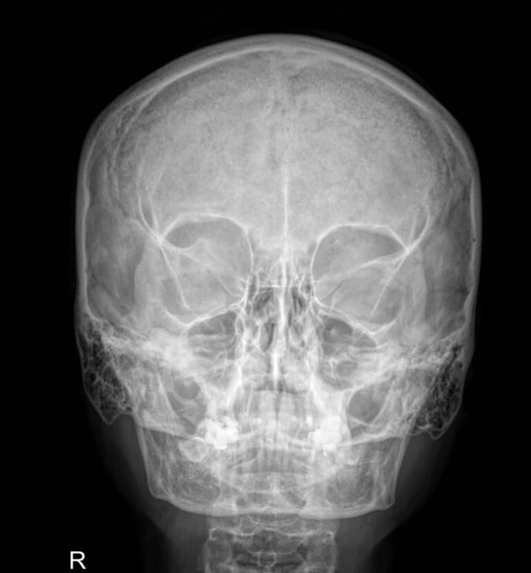 Рентген черепа в двух проекциях