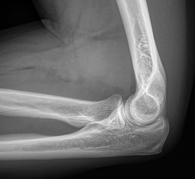 Рентген локтевого сустава