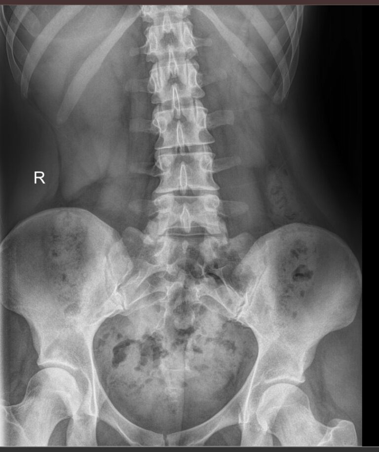 Рентген почек, мочеточников, мочевого пузыря