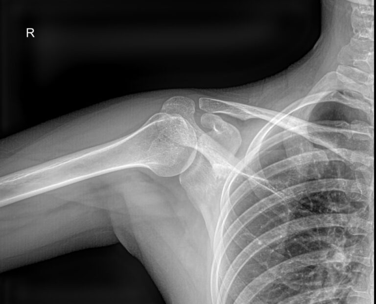 Рентген плечевой кости