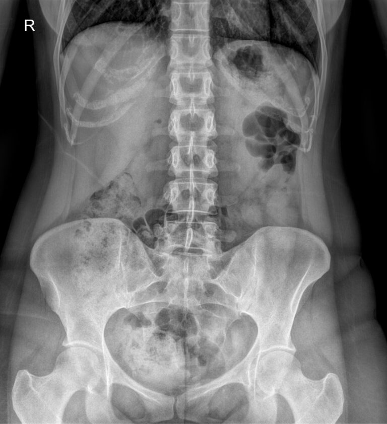 Обзорный рентген брюшной полости