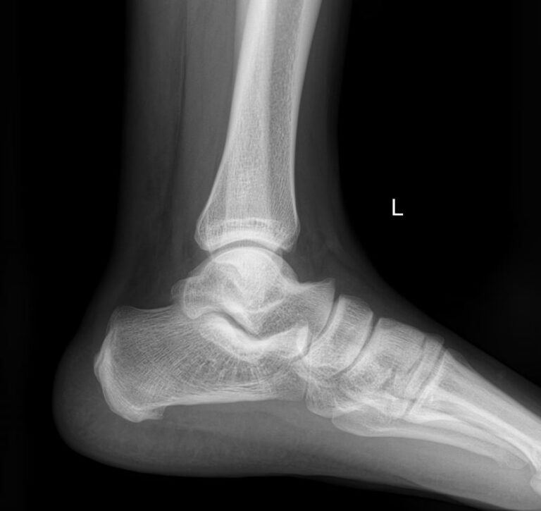 Рентген голеностопных суставов