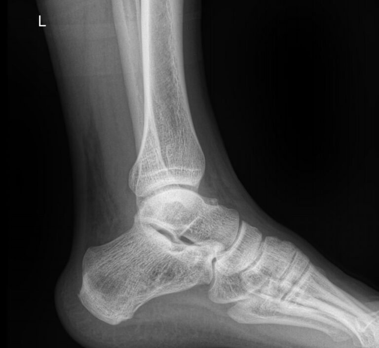 Рентген голеностопного сустава