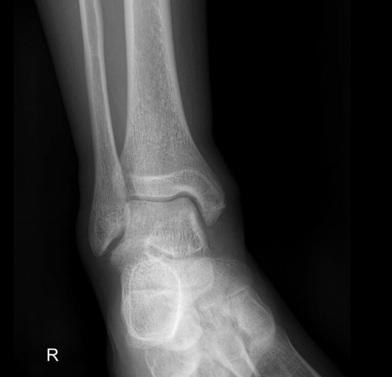 Рентген голеностопных суставов