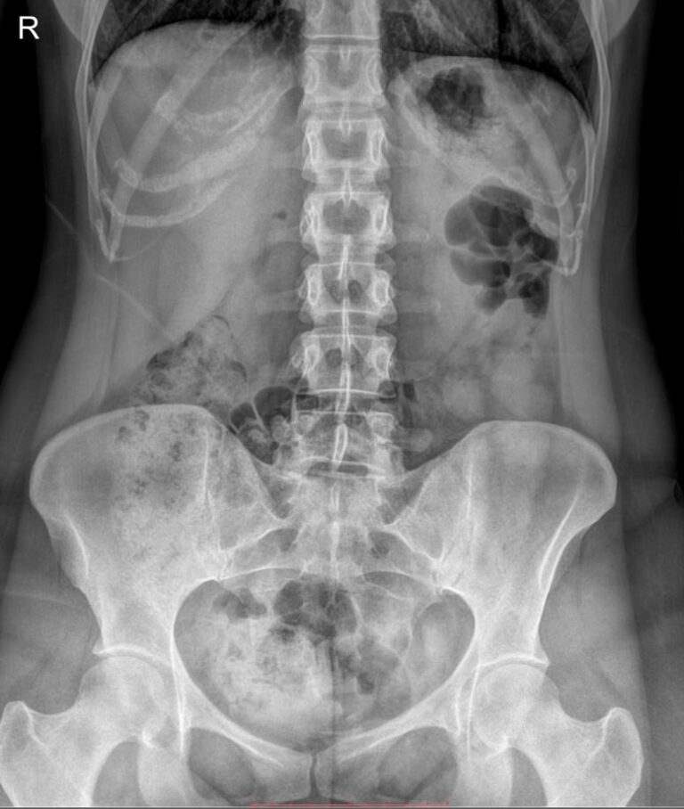 Рентген почек, мочеточников, мочевого пузыря