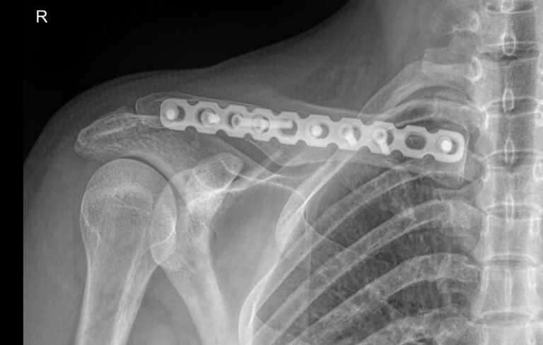 Рентген ключицы