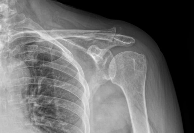 Рентген акромиально-ключичного сочленения