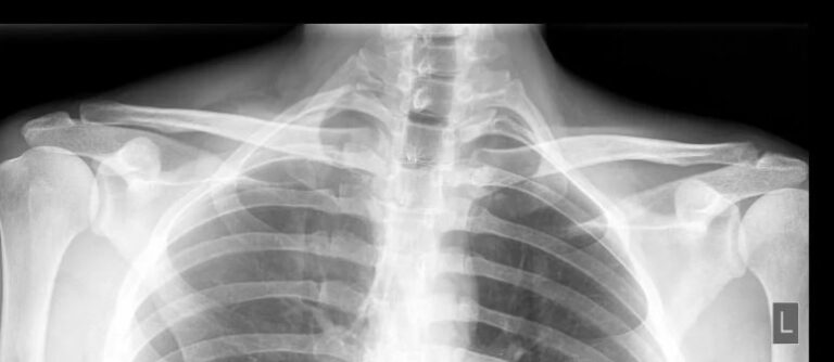 Рентген обоих акромиально-ключичных сочленений