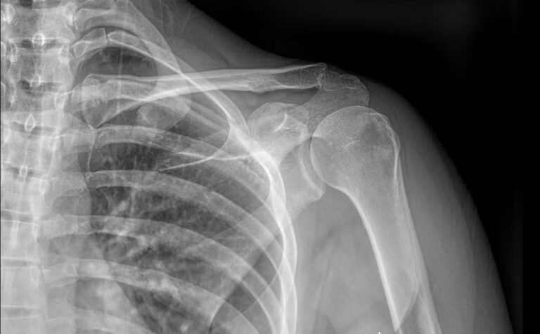 Рентген грудино-ключичных сочленений