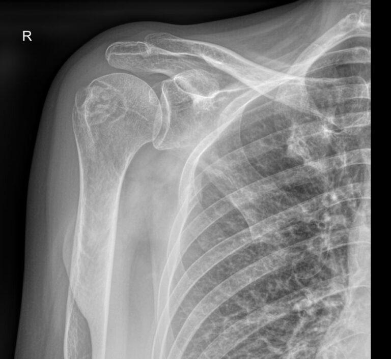 Рентген плечевого сустава