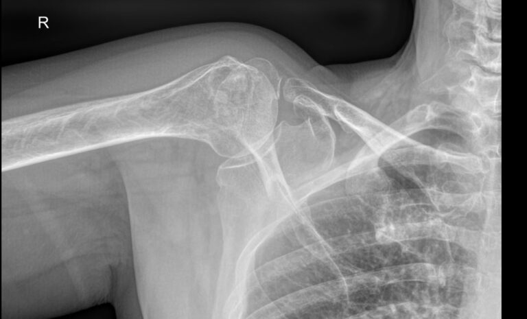 Рентген плечевого сустава 2 проекции