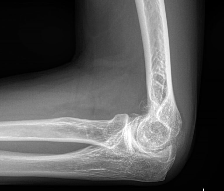 Рентген локтевого сустава