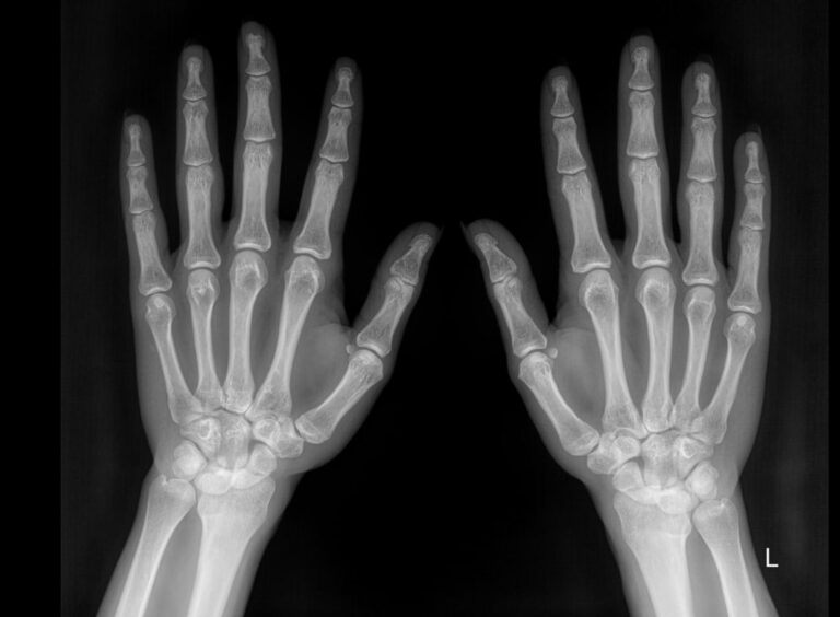 Рентген обеих кистей