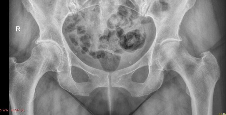 Рентген тазобедренных суставов в прямой проекции и по Лаунштейну