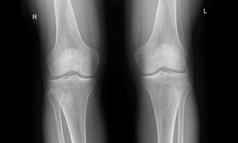 Рентген обоих коленных суставов
