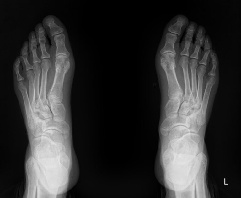Рентген стоп в прямой проекции