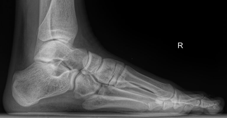 Рентген одной стопы на продольное плоскостопие