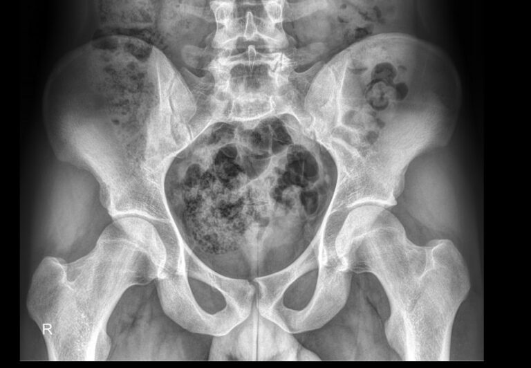 Обзорный рентген малого таза