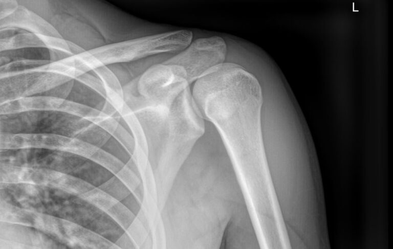 Рентген акромиально-ключичного сочленения