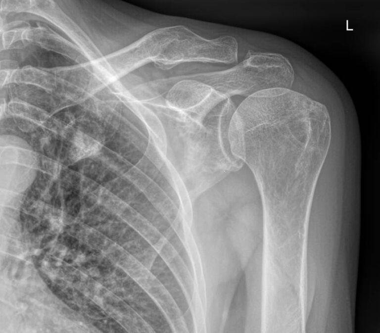 Рентген плечевого сустава