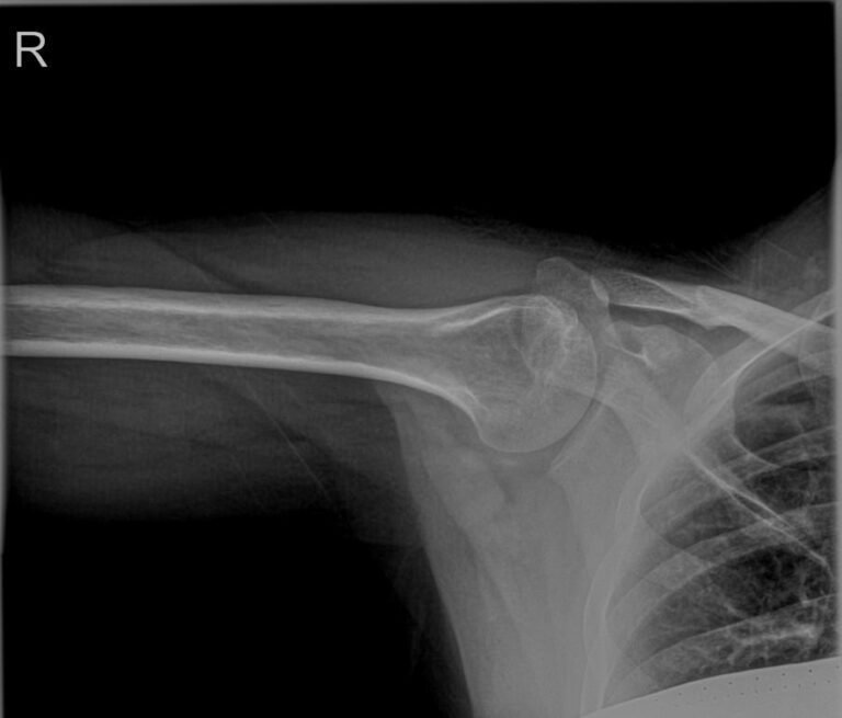 Рентген плечевой кости