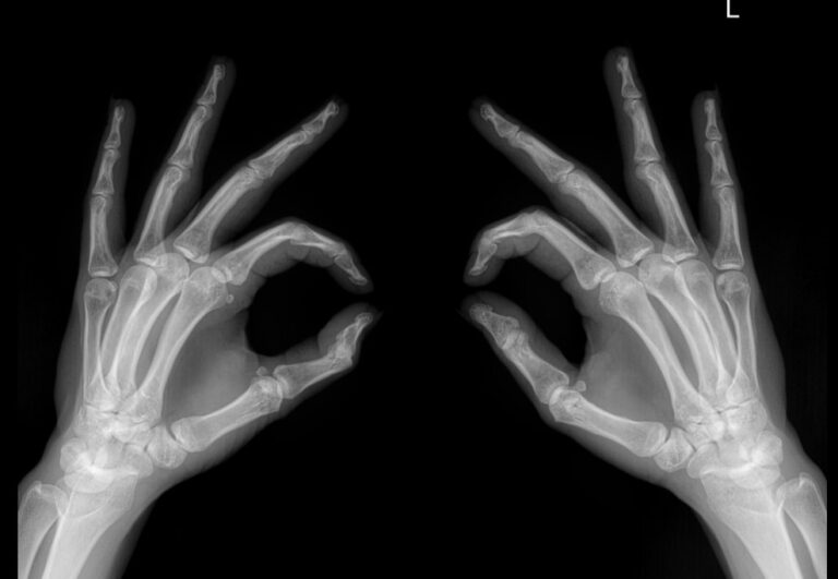 Рентген обеих кистей