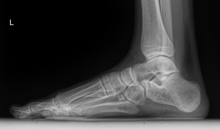 Рентген одной стопы на продольное плоскостопие