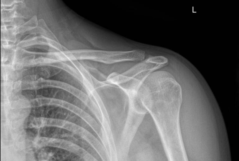 Рентген акромиально-ключичного сочленения