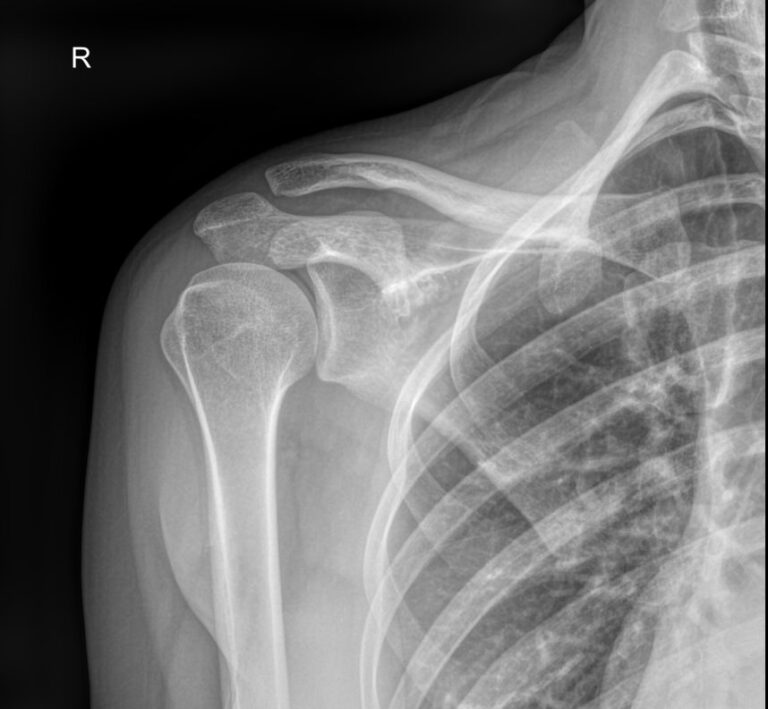 Рентген плечевой кости