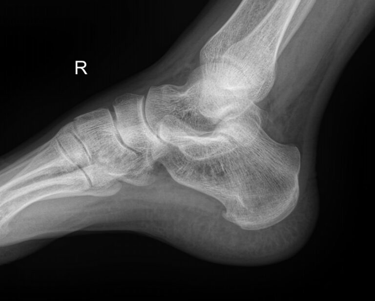 Рентген пяточных костей