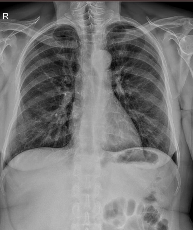 Рентген ребер