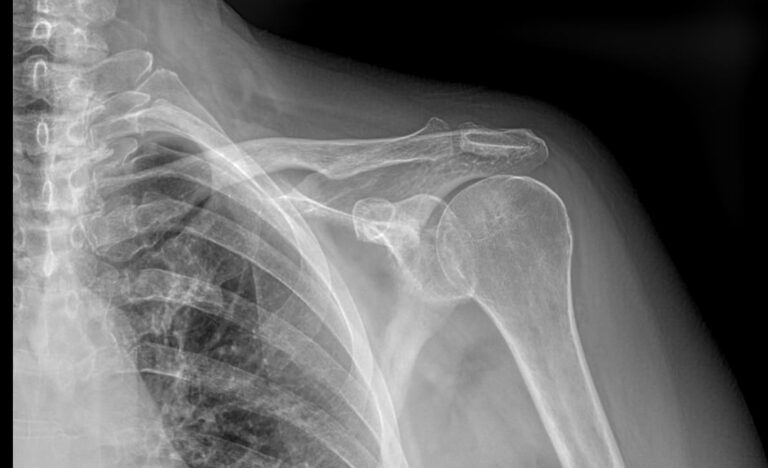 Рентген грудино-ключичных сочленений