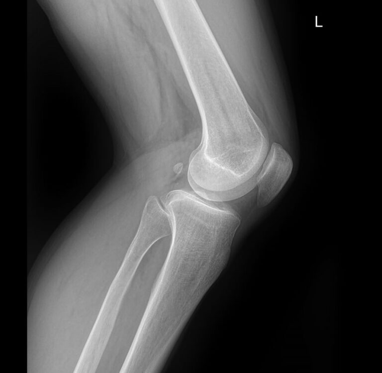 Рентген обоих коленных суставов