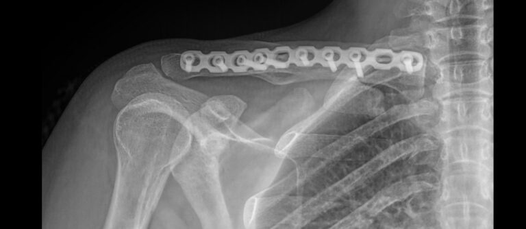 Рентген ключицы