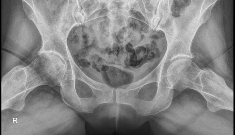 Рентген тазобедренных суставов в прямой проекции и по Лаунштейну