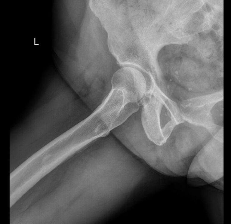 Рентген тазобедренных суставов