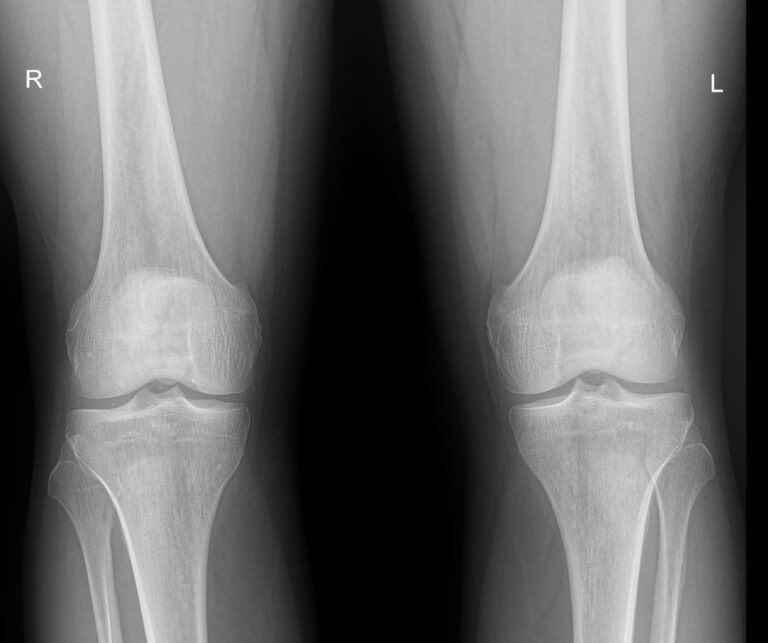 Рентген обоих коленных суставов