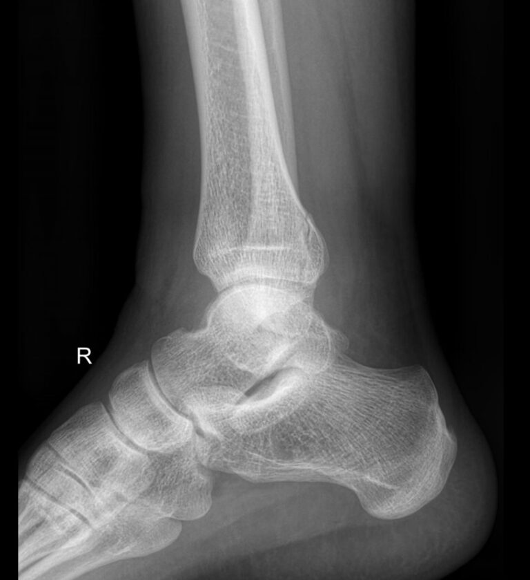 Рентген голеностопных суставов