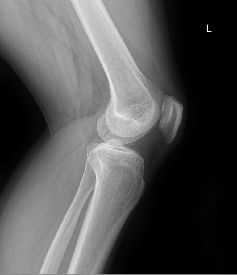 Рентген обоих коленных суставов