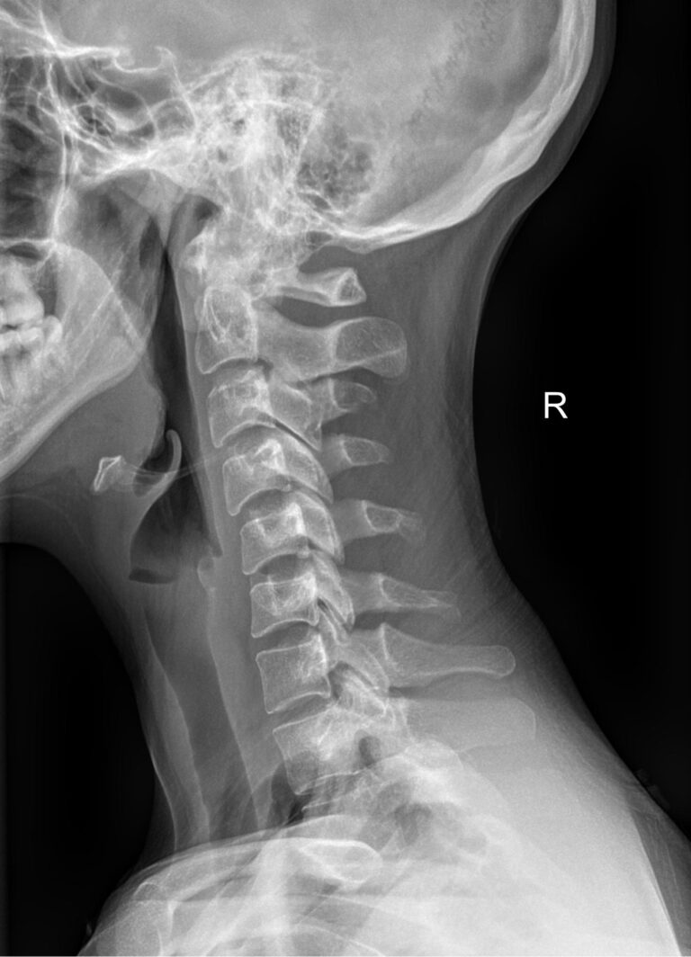 Функциональные исследования позвоночника (шейный отдел)