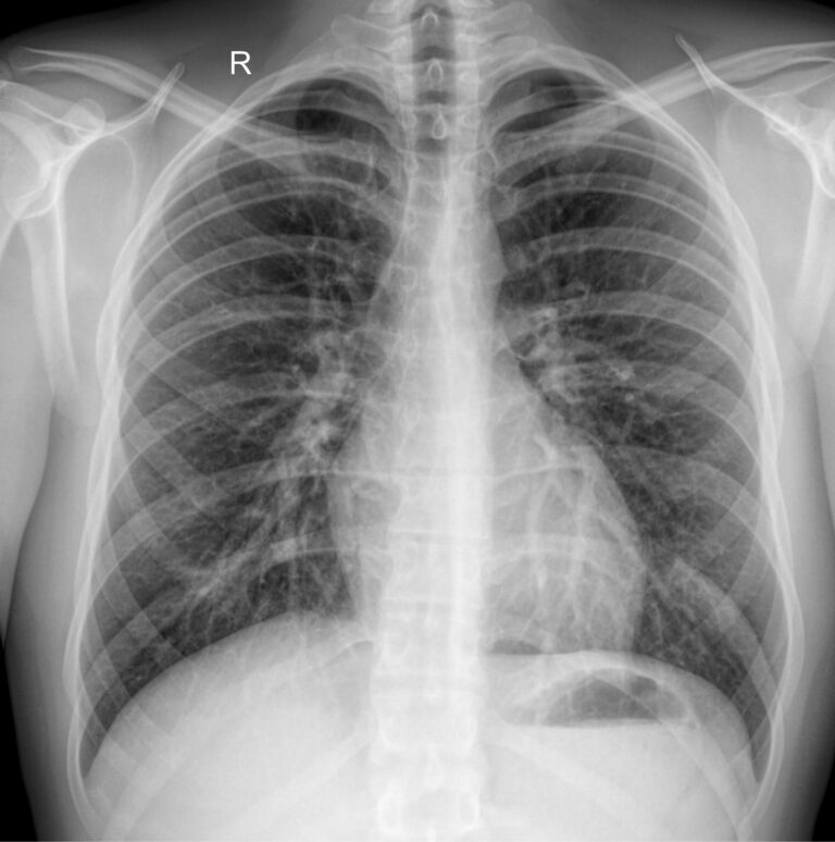 Рентген грудной клетки 1 проекция