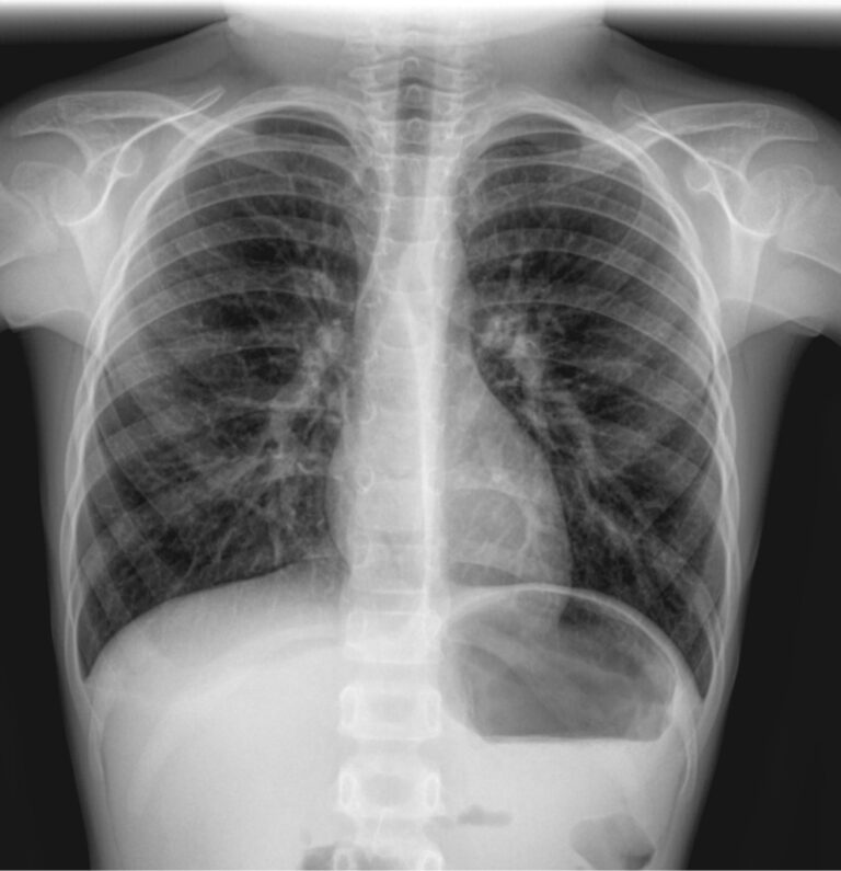 Рентген грудной клетки 2 проекции