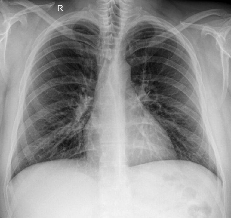 Рентген грудной клетки 1 проекция