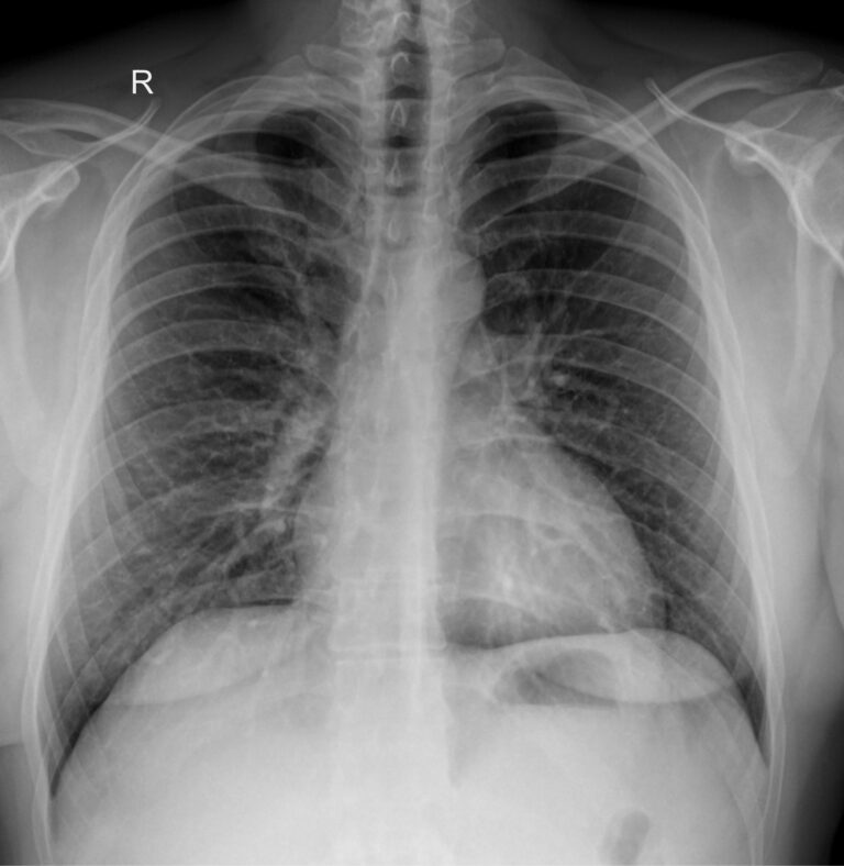 Рентген грудной клетки 1 проекция