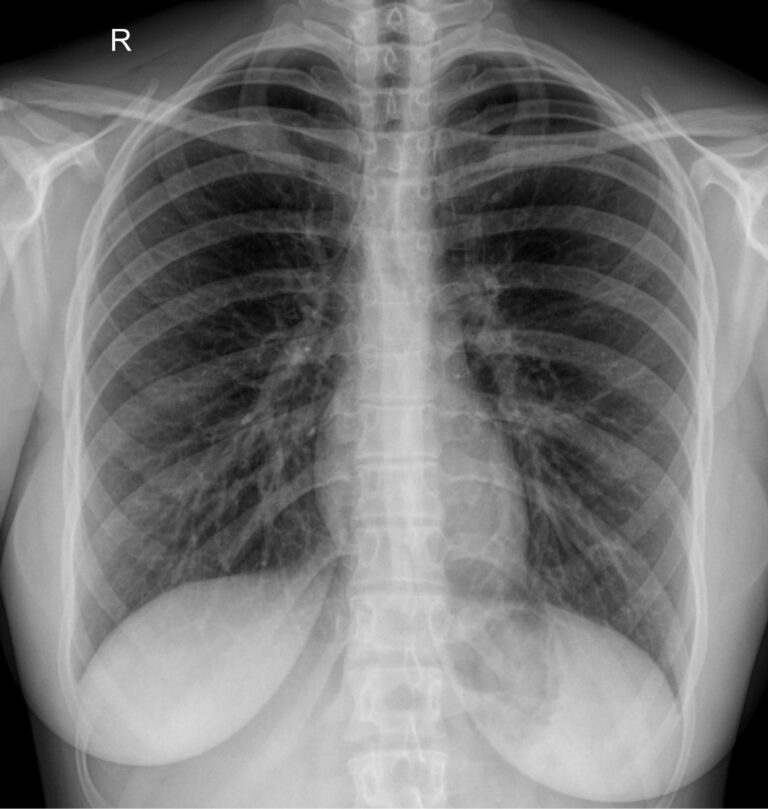 Рентген грудной клетки 1 проекция
