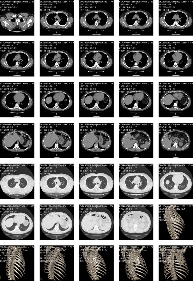 Обзорный рентген брюшной полости