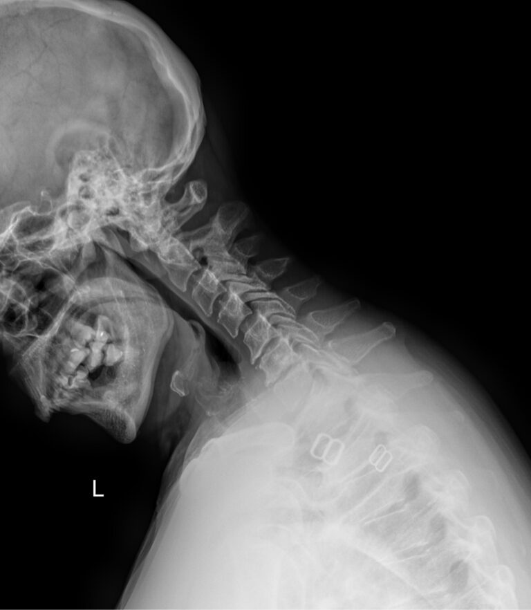 Функциональные исследования позвоночника (шейный отдел)