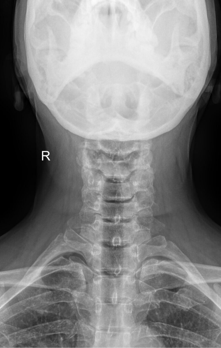 Функциональные исследования позвоночника (шейный отдел)